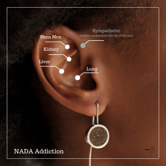 Ear Seeds. NADA addiction and weight loss protocol 