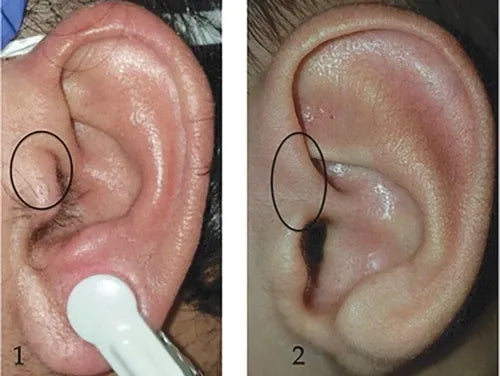 Auricular markers of Covid-19